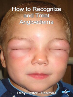 cover image of How to Recognize and Treat Angioedema
